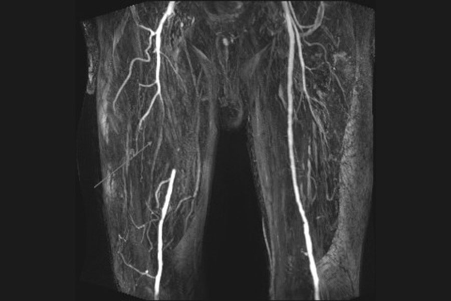 Magnetresonanztomographische Gefäßdarstellung der Beinschlagadern mit Nachweis eines Verschlusses der rechten Oberschenkelarterie