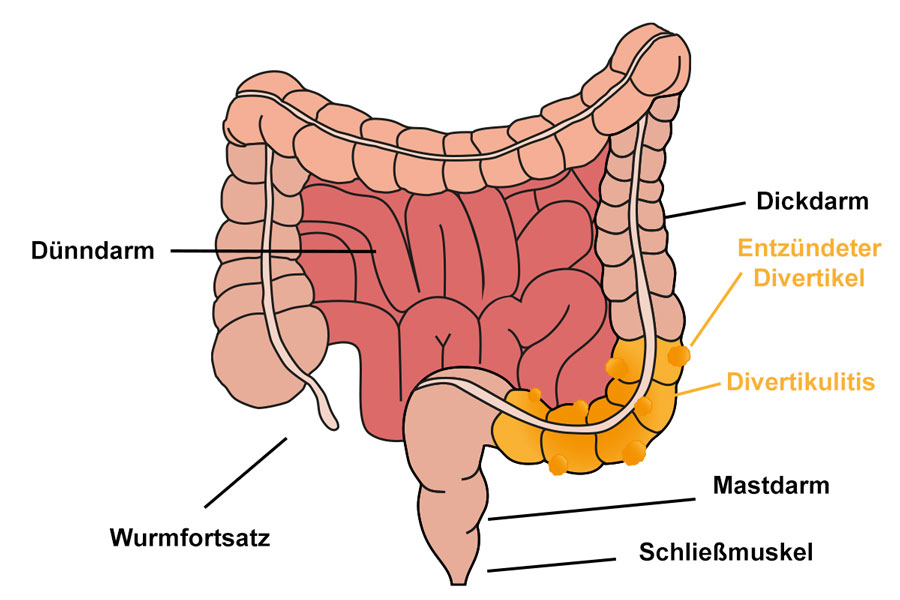 Anatomie Darm mit Divertikulitis