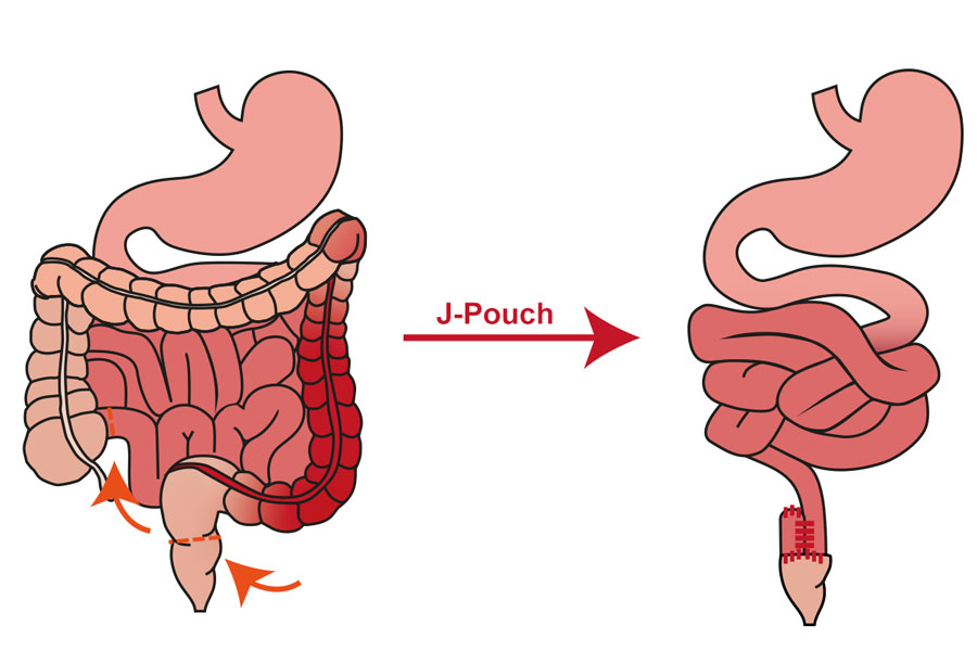 Operation J-Pouch bei Colitis ulcerosa