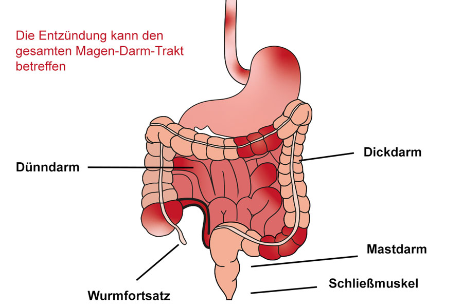 Anatomie Darm mit Morbus Crohn