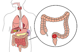 Anatomie Darmkrebs